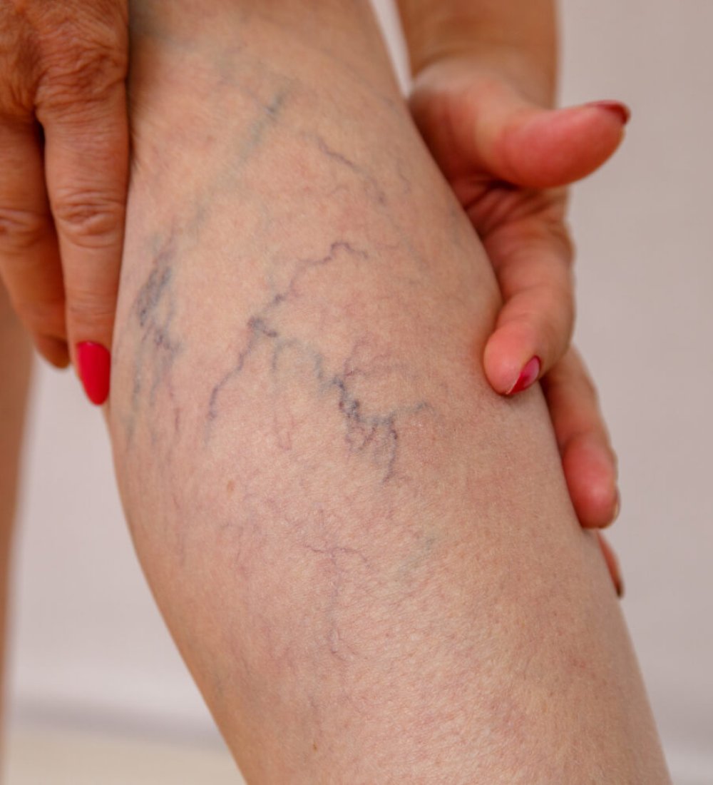 Tratamientos de estética con láser para eliminar arañas vasculares en Aspe